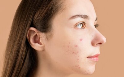 Ontstaan er darmklachten bij rosacea en acne?