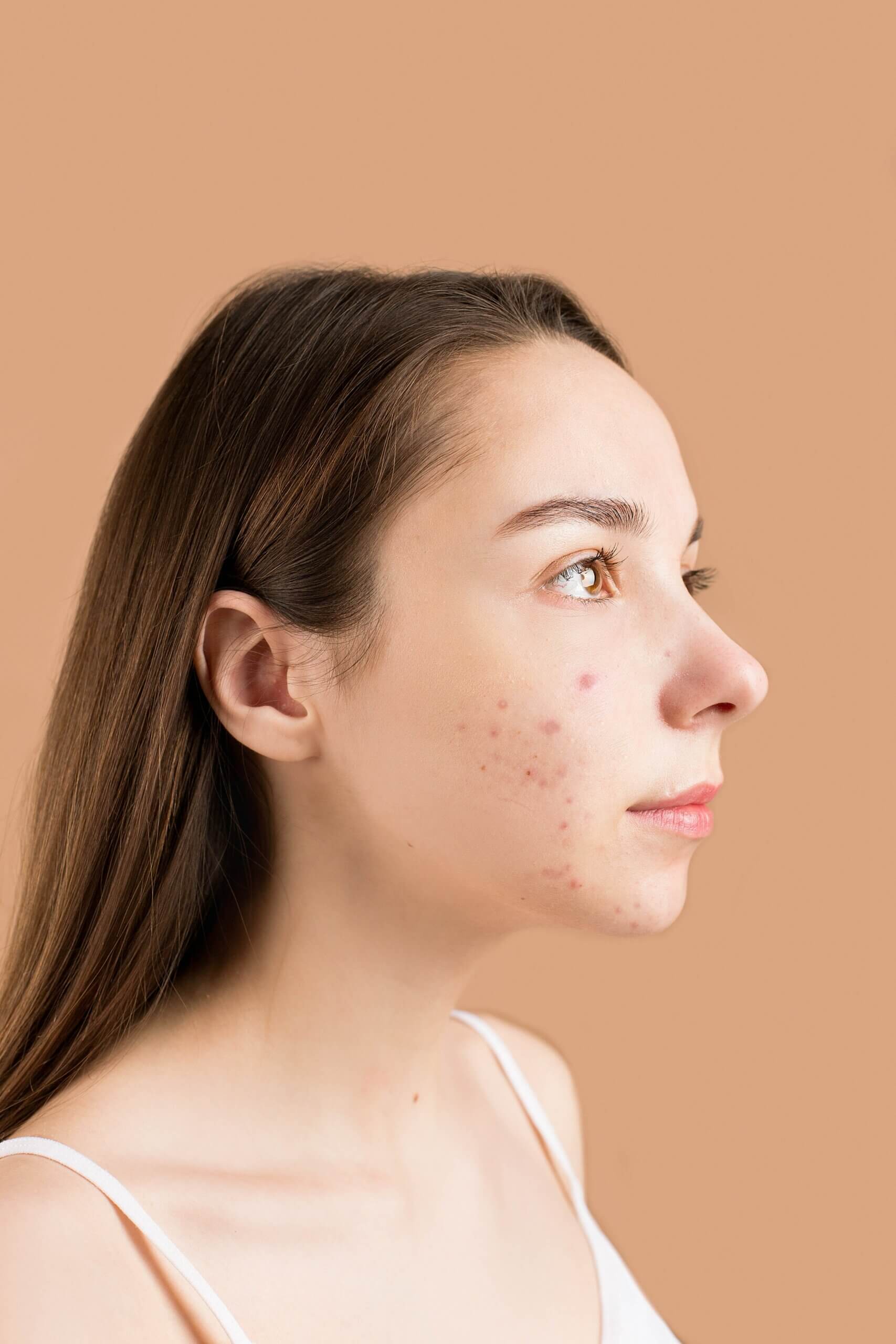 Ontstaan er darmklachten bij rosacea en acne?
